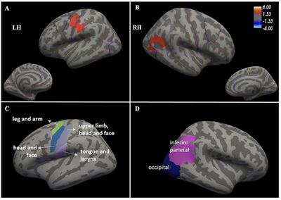 Speech motor impairment in ALS is associated with multiregional cortical thinning beyond primary motor cortex